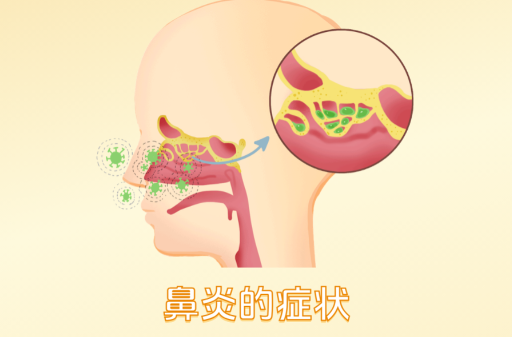 一到换季就打喷嚏流鼻涕?反复鼻炎发作,不只是感冒那么简单